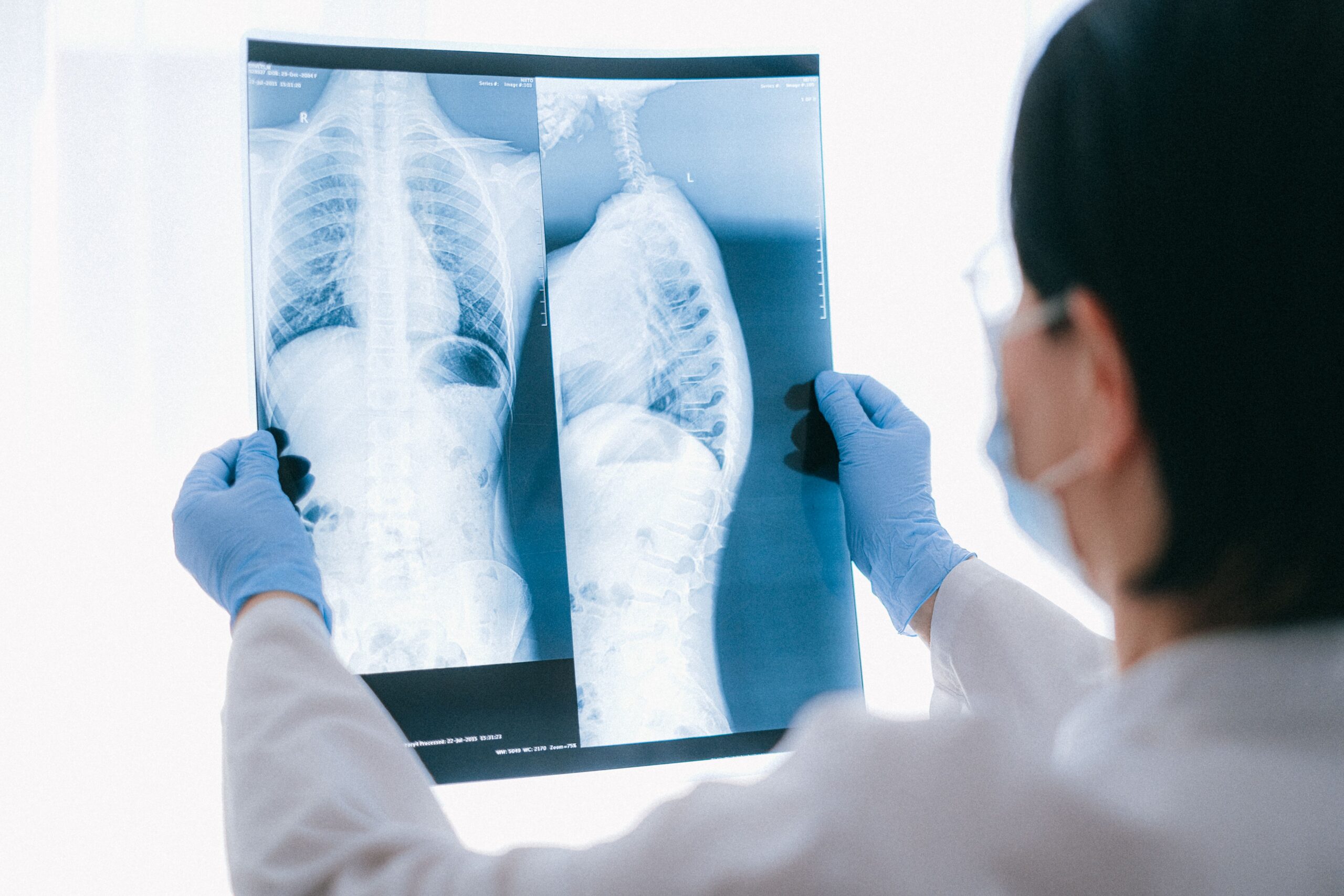 Microplastics linked to lung cancer